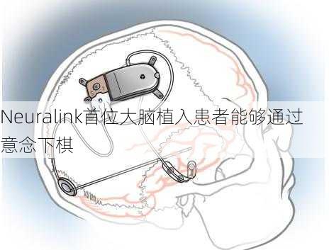 Neuralink首位大脑植入患者能够通过意念下棋